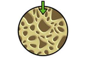 Ejercicio y Osteoporosis 